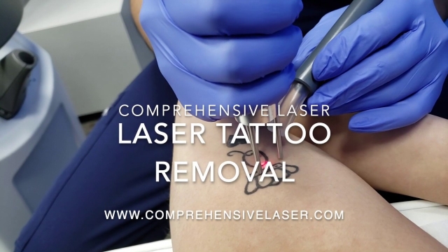 Feelings Don’t Last Forever So Tattoo Removal Is A Brilliant Option