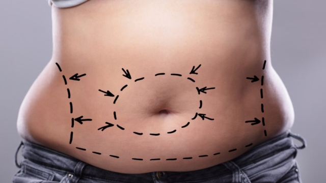 From Flab to Fab: The Ultimate Guide to Tummy Tucks