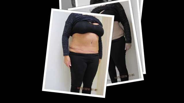 Sculpting Your Silhouette: Unlocking the Secrets of the Tummy Tuck