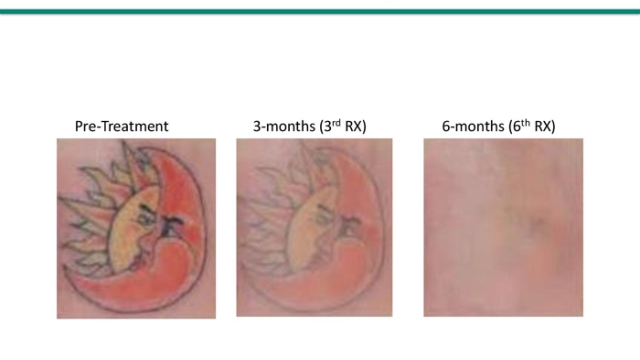 Dermatologists And Removal Of Tattoos