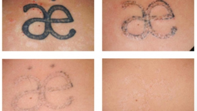 Is Tca Tattoo Removal Something That You Have To Consider?